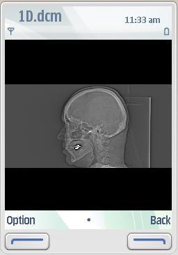 DICOM on Nokia